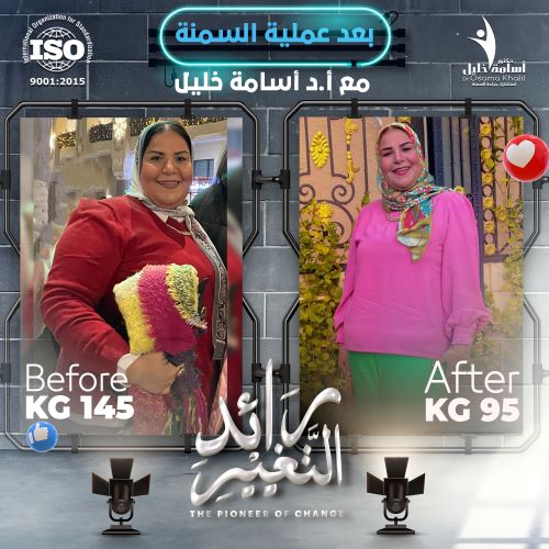 حقنة بديل تكميم المعدة